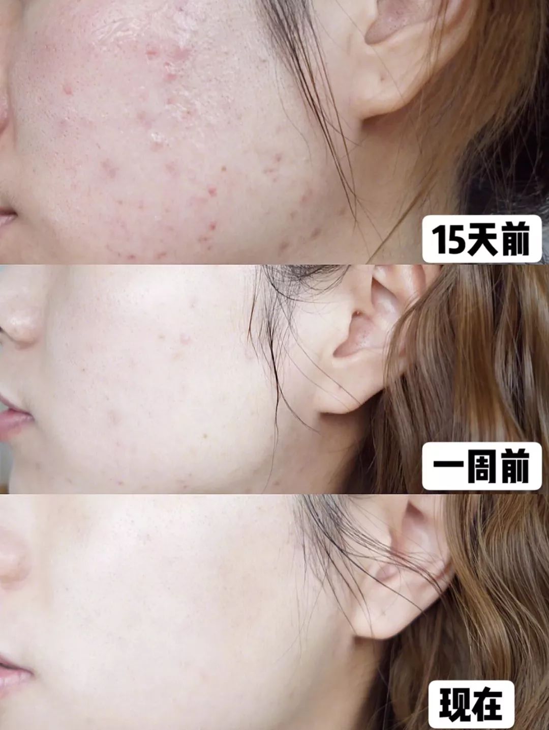 鼻头总是挤出白色丝条中医辨证,鼻头一挤就有白丝