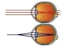 青少年近视小儿推拿防控,小儿推拿可以治弱视吗