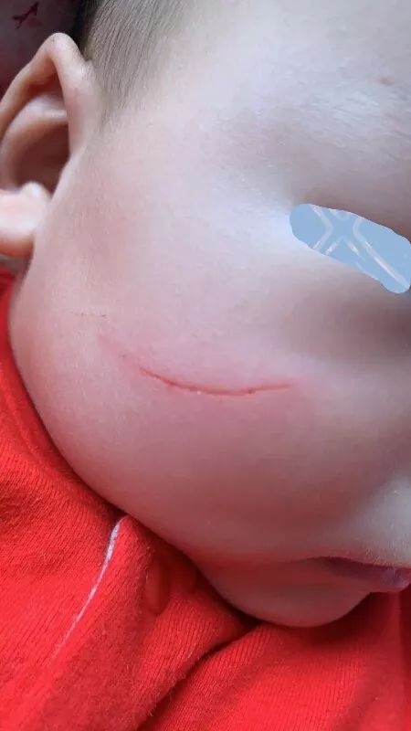 面部伤口美容缝合后关注事项,面部美容缝合视频