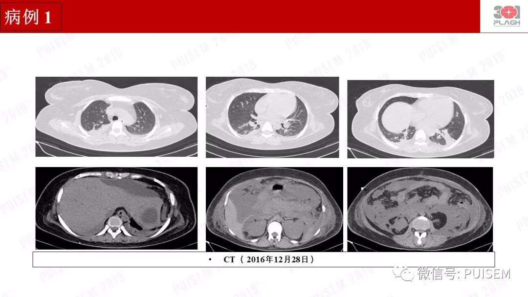精彩幻灯｜朱海燕：血液净化的抗凝治疗