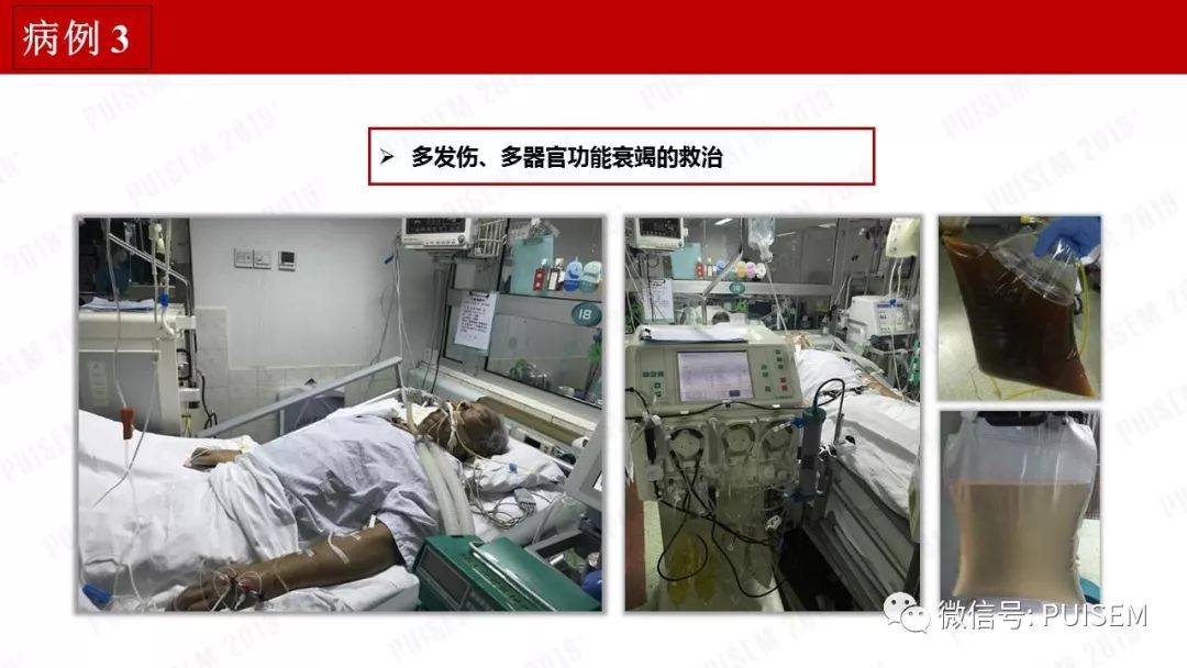 精彩幻灯｜朱海燕：血液净化的抗凝治疗