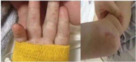 手足口病高发怎么防护看这里,现在是手足口病高发季怎么预防