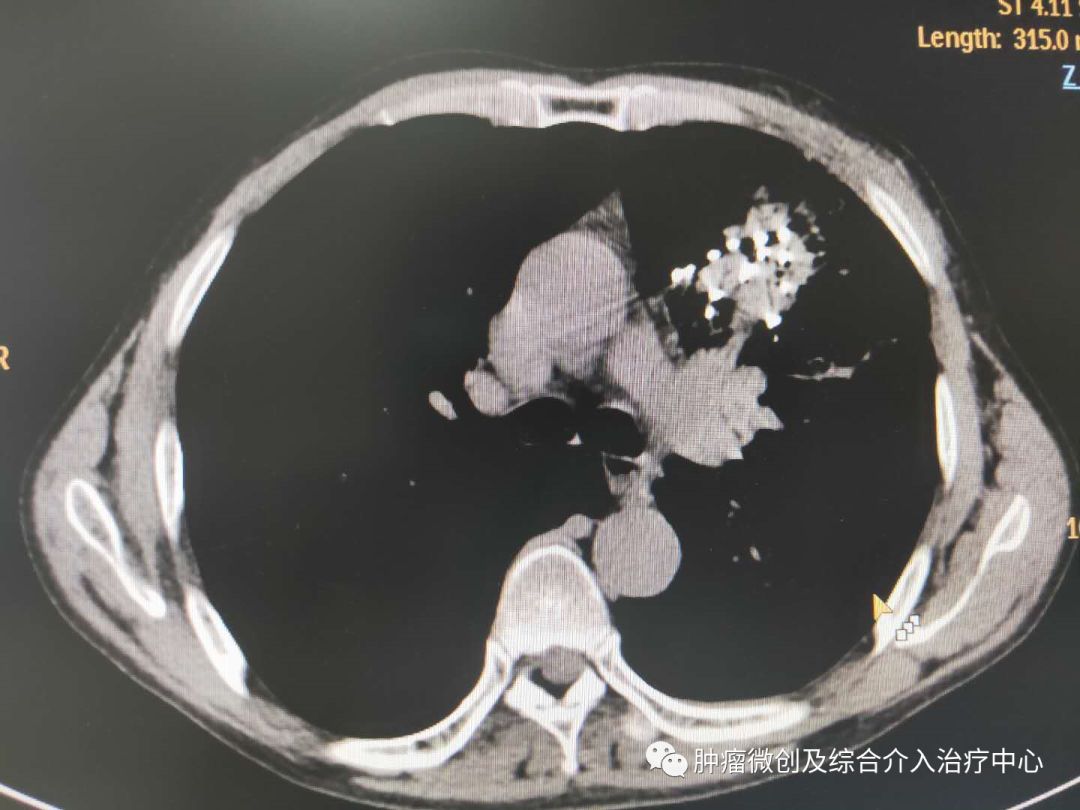 哪些肿瘤患者适合微创介入治疗,晚期癌症能做碘125粒子植入术
