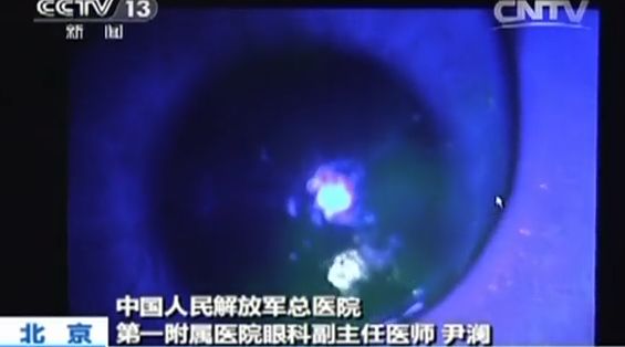 正在被美瞳毁掉的女孩,正在被美瞳毁掉的女人们