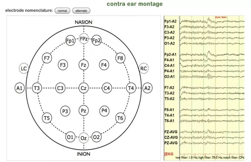 正常脑电图报告单图片,正常脑电图检查报告单第一页