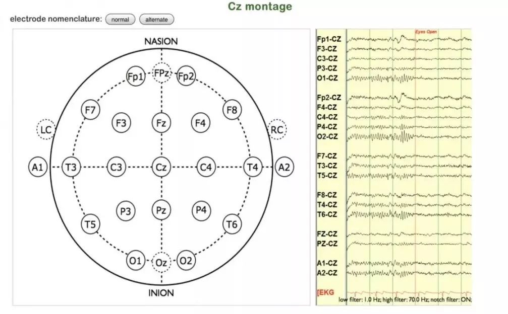 正常脑电图报告单图片,正常脑电图检查报告单第一页