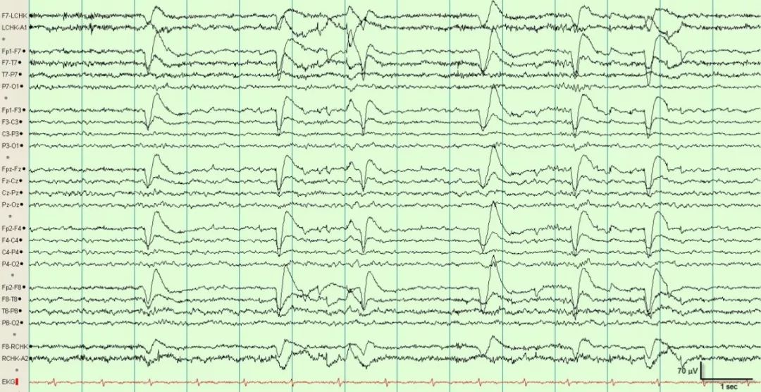 正常脑电图报告单图片,正常脑电图检查报告单第一页