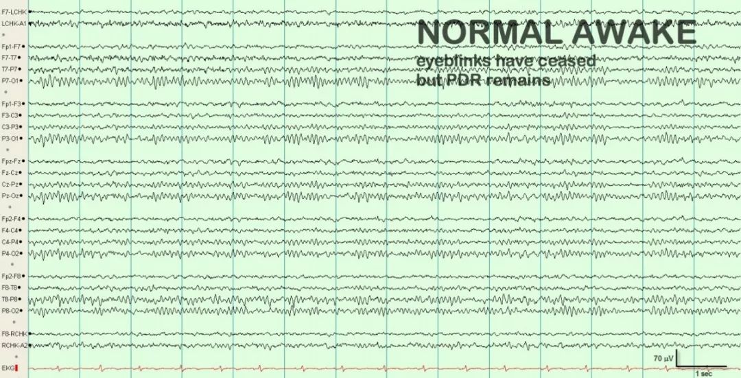 正常脑电图报告单图片,正常脑电图检查报告单第一页