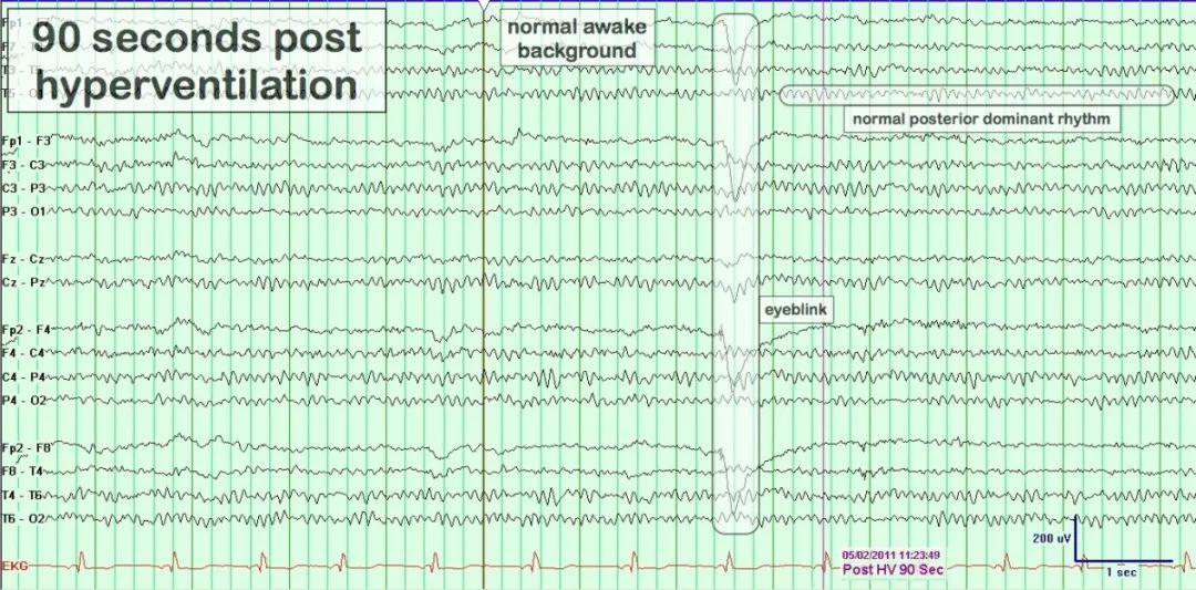 正常脑电图报告单图片,正常脑电图检查报告单第一页