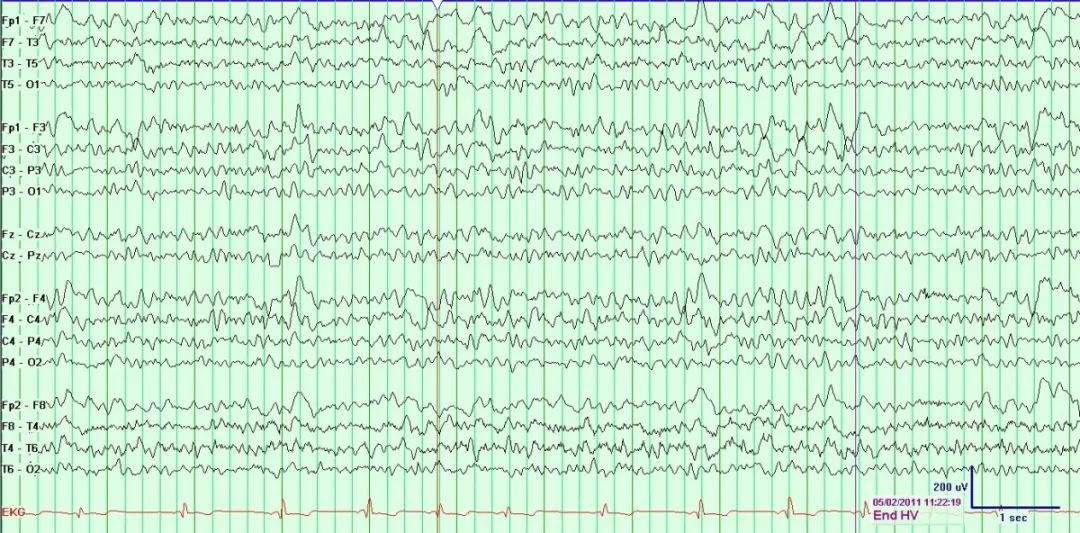 正常脑电图报告单图片,正常脑电图检查报告单第一页