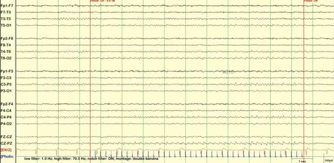 正常脑电图报告单图片,正常脑电图检查报告单第一页