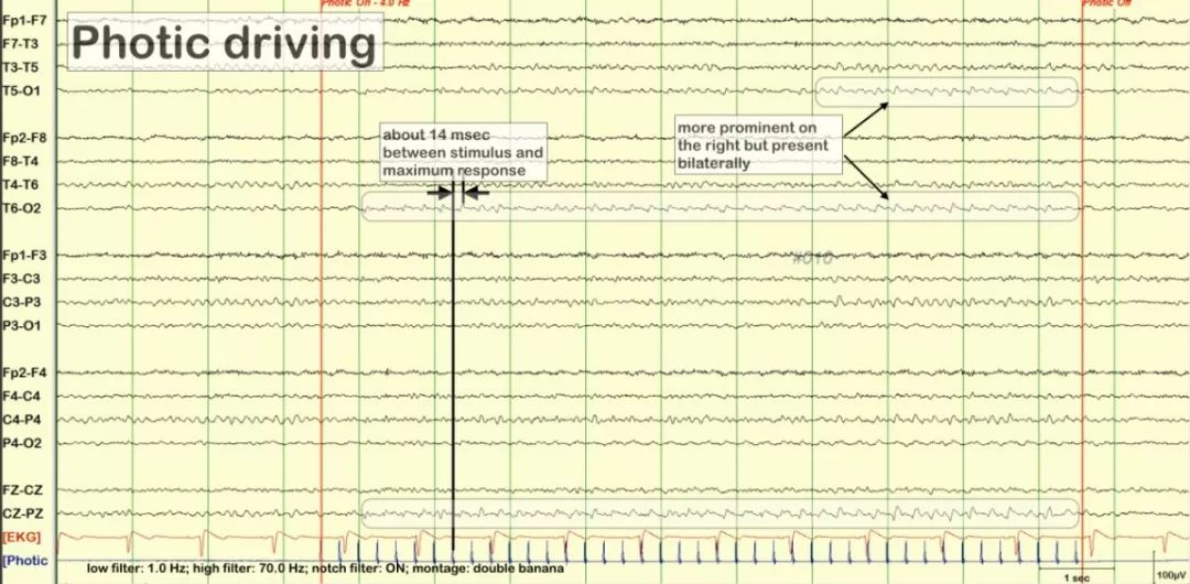 正常脑电图报告单图片,正常脑电图检查报告单第一页