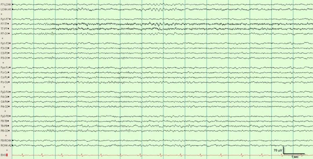 正常脑电图报告单图片,正常脑电图检查报告单第一页