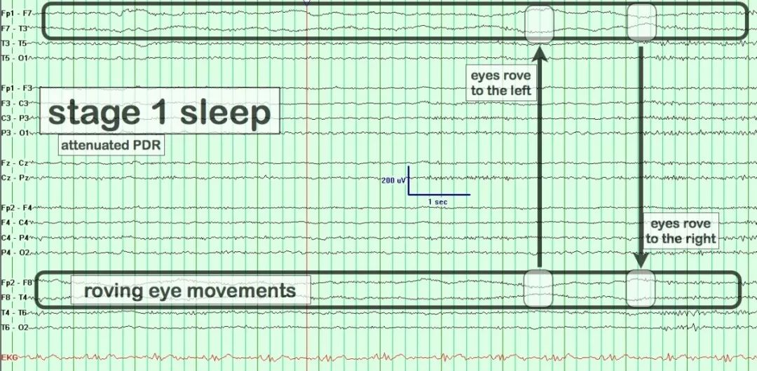 正常脑电图报告单图片,正常脑电图检查报告单第一页