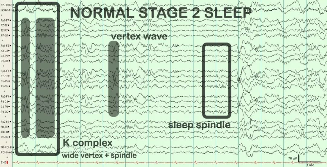 正常脑电图报告单图片,正常脑电图检查报告单第一页