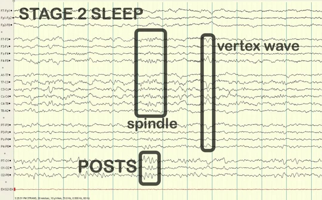 正常脑电图报告单图片,正常脑电图检查报告单第一页