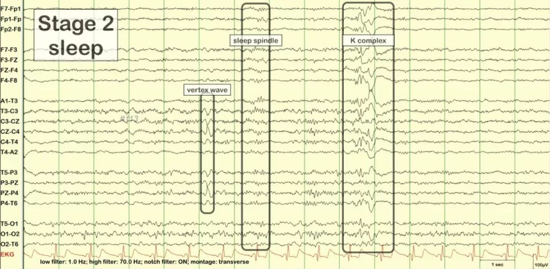 正常脑电图报告单图片,正常脑电图检查报告单第一页