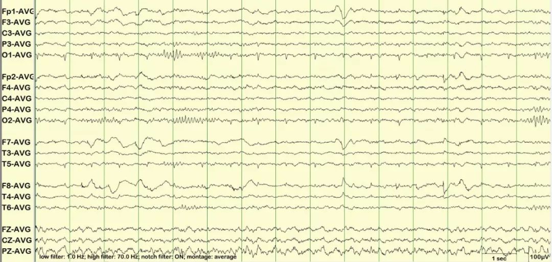 正常脑电图报告单图片,正常脑电图检查报告单第一页