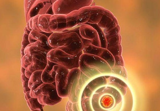 女孩每天放屁数十次确诊肠癌,女子放屁肠癌