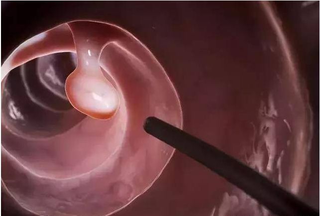 女孩每天放屁数十次确诊肠癌,女子放屁肠癌