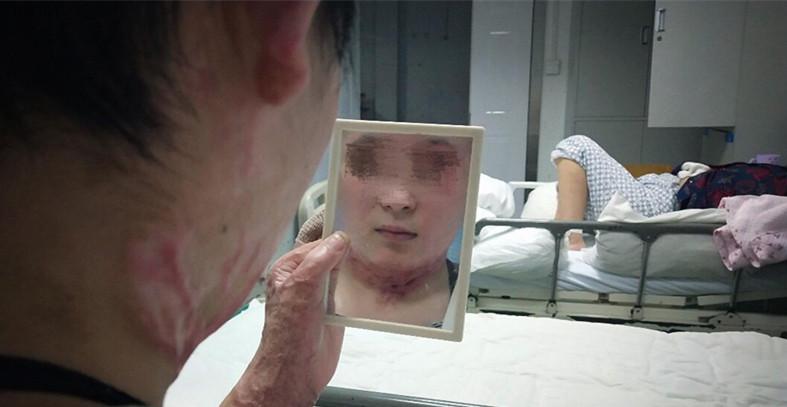 16岁女孩救弟弟严重烧伤,11岁少年救妹妹被火烧伤