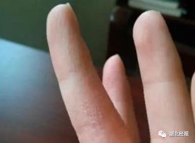 手上起小水泡很痒还脱皮传染吗,五月份手上起小水泡很痒怎么办