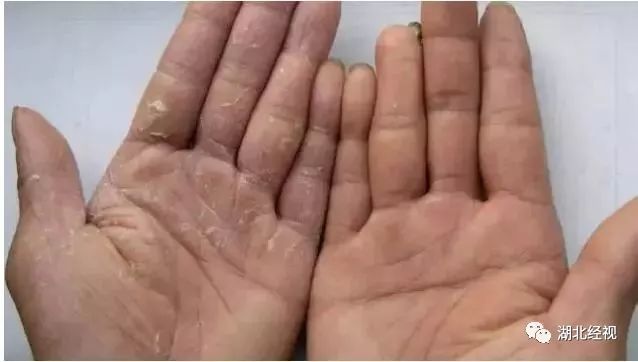 手上起小水泡很痒还脱皮传染吗,五月份手上起小水泡很痒怎么办