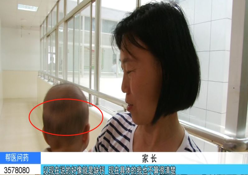 婴儿一直补钙还枕秃,9个月宝宝枕秃成圈状需要补钙吗