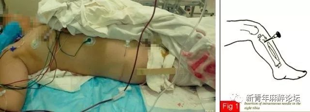 护士不知晓输血反应流程原因分析,护士不知晓输血反应的原因分析