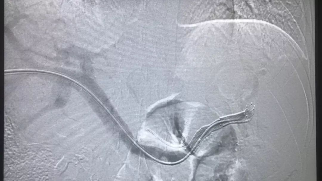 介入治疗消化道出血成功案例,介入科消化道出血
