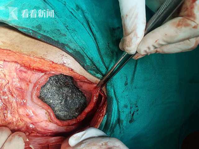 俄罗斯16岁少女肚皮鼓肿如孕妇医生手术取出11斤重“毛怪物”