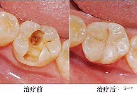 乳牙龋齿的危害及预防医师在线,有关乳牙龋病的预防