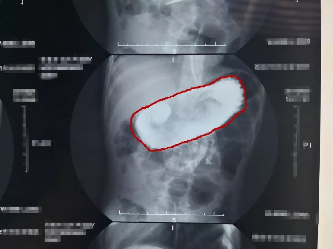 小孩吃了一根头发到肚子里怎么办,小孩吃了一根头发进肚子里