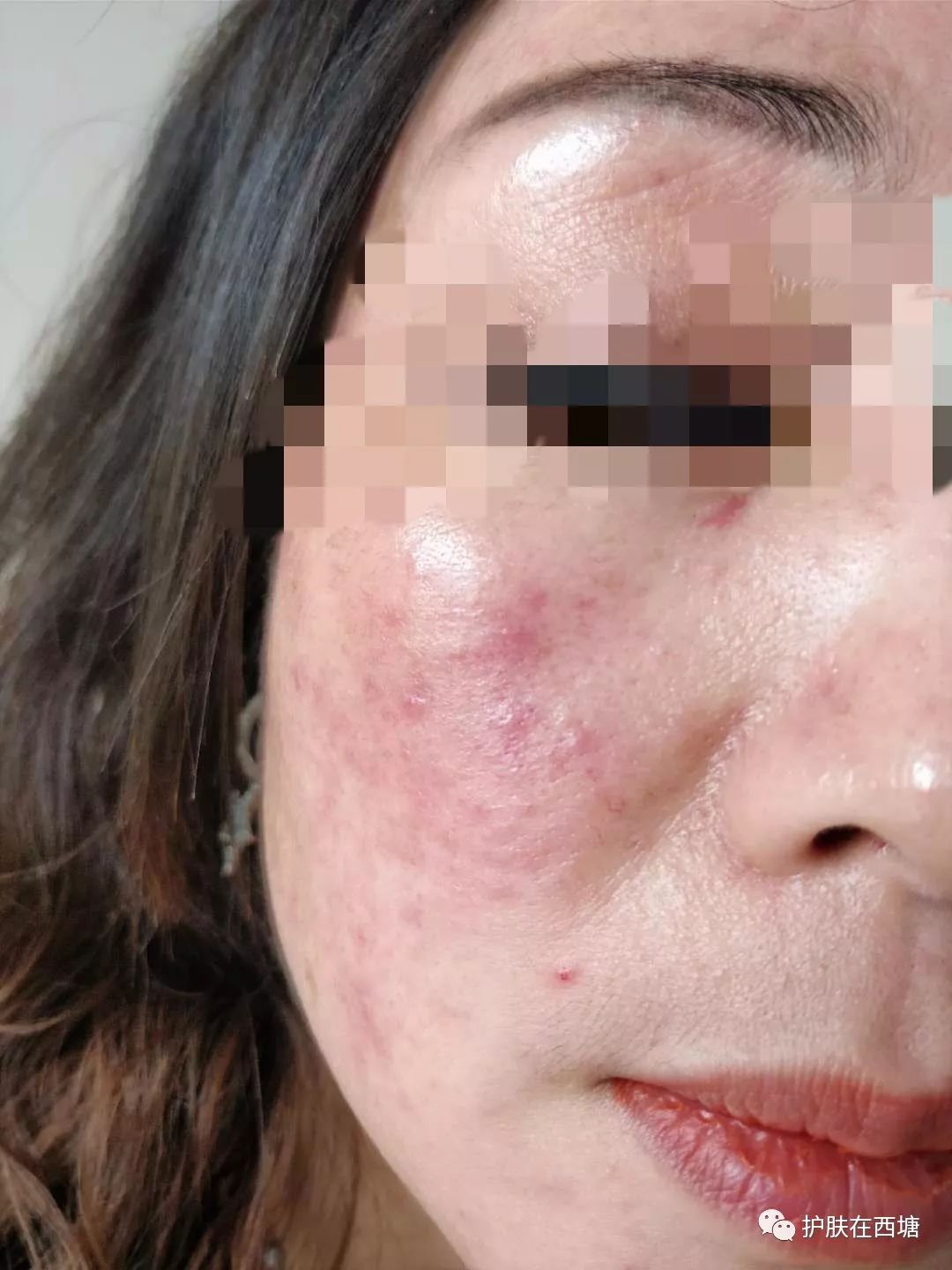 关于皮肤皮炎的几种症状,面部激素依赖性皮炎能好吗