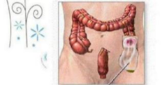 造口患者标准护理流程,造口的正确护理方法