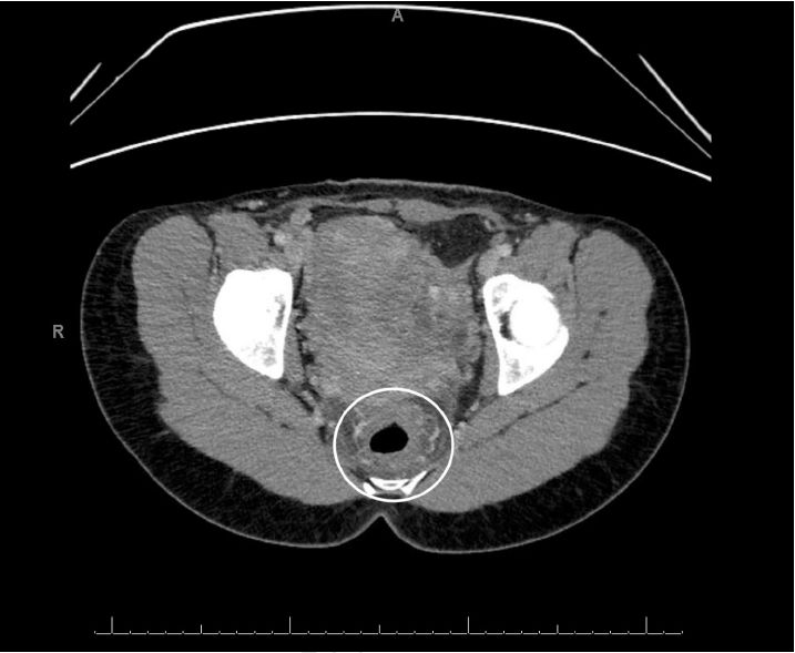 病例分享|一键保存！年轻女性因直肠疼痛而无法坐下？