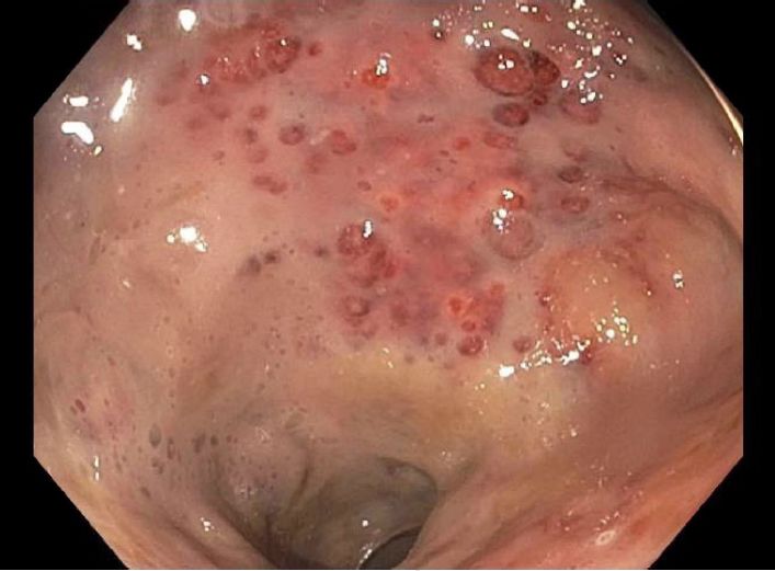 病例分享|一键保存！年轻女性因直肠疼痛而无法坐下？