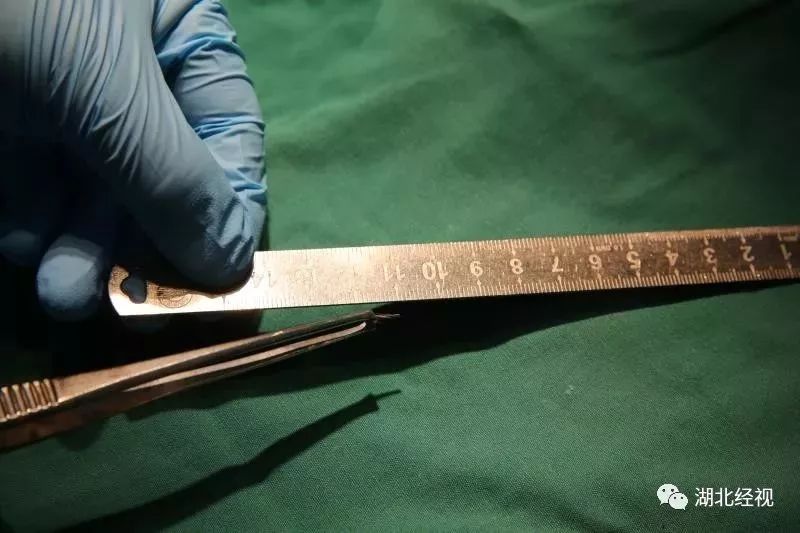 担心的事发生了！九江女子看牙时，钻针突然断掉，扎进面部后失踪了