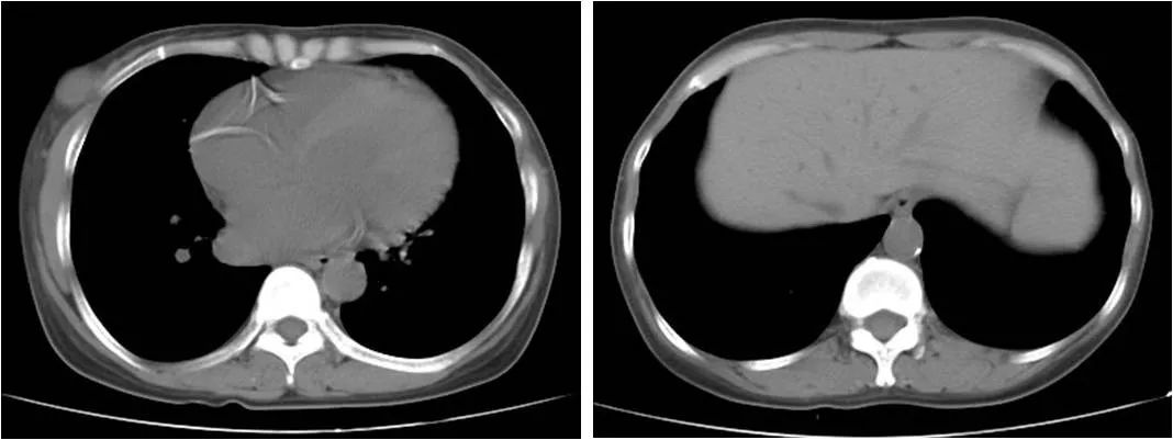 继发性甲旁亢的护理,继发性甲旁亢自己能治愈吗
