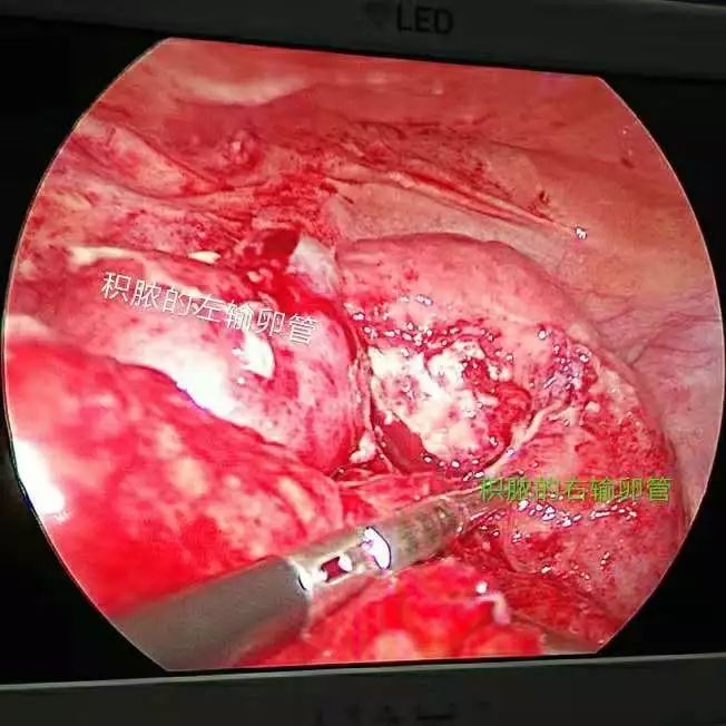 挑战│克服重重困难，腹腔镜为患者解除病痛