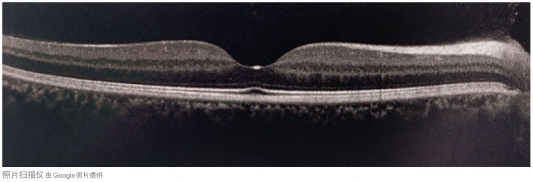 眼底黄斑病变一般多久会失明,眼底黄斑病的养护和关注事项