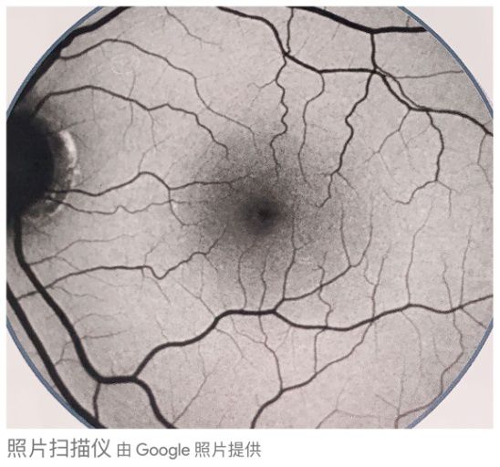 眼底黄斑病变一般多久会失明,眼底黄斑病的养护和关注事项