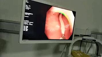 女子肚子疼上医院一查,女子肚子疼去医院检查吓到医生