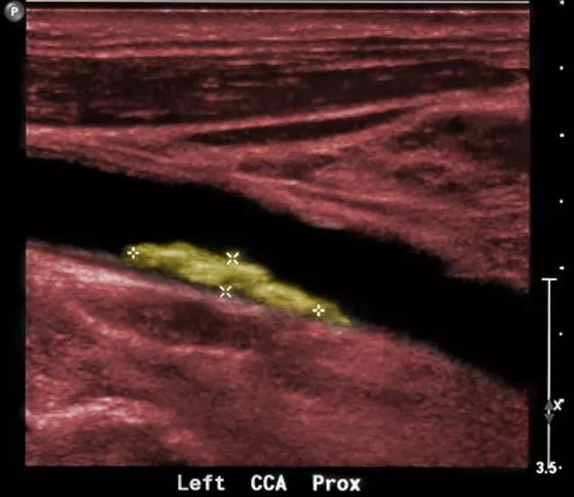 动脉硬化最新检查手段,动脉硬化最佳检查方法