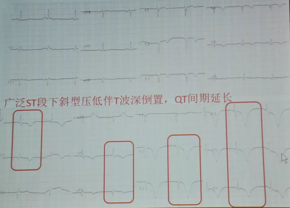 冠脉痉挛的诊疗分析,冠脉痉挛的临床诊断方法