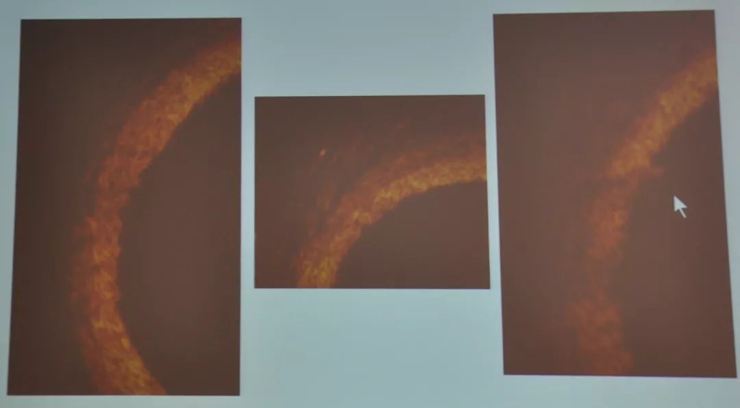 冠脉痉挛的诊疗分析,冠脉痉挛的临床诊断方法