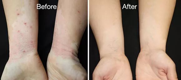 痒？给你一支“不求人”