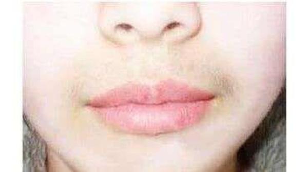 女生胡子已经刮了怎么办,怎么刮胡子避免唇周黑