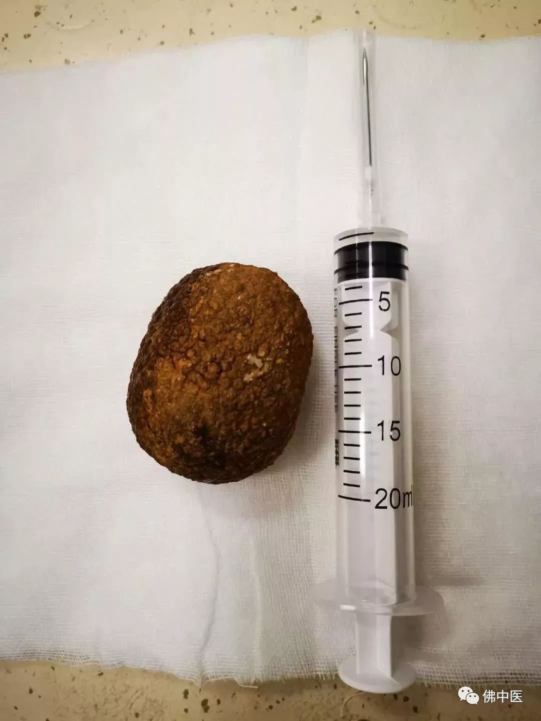 70岁老人前列腺肥大膀胱结石,膀胱巨大结石的症状