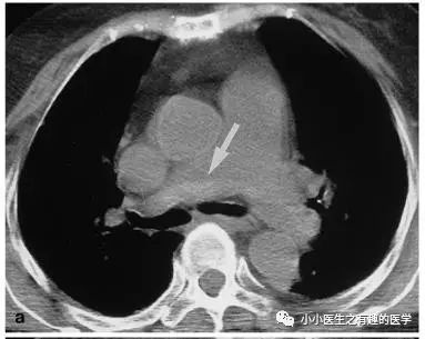 ct平扫肺部能查出是哮喘吗,ct平扫肺结节准确吗